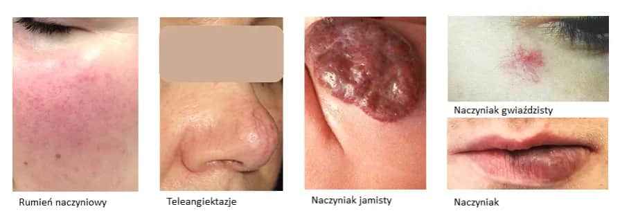 Zmiany naczyniowe na skórze: przyczyny, objawy i skuteczne leczenie