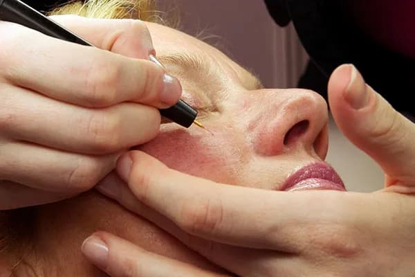 Skuteczne zabiegi na twarz naczynkową - 5 metod leczenia naczynek