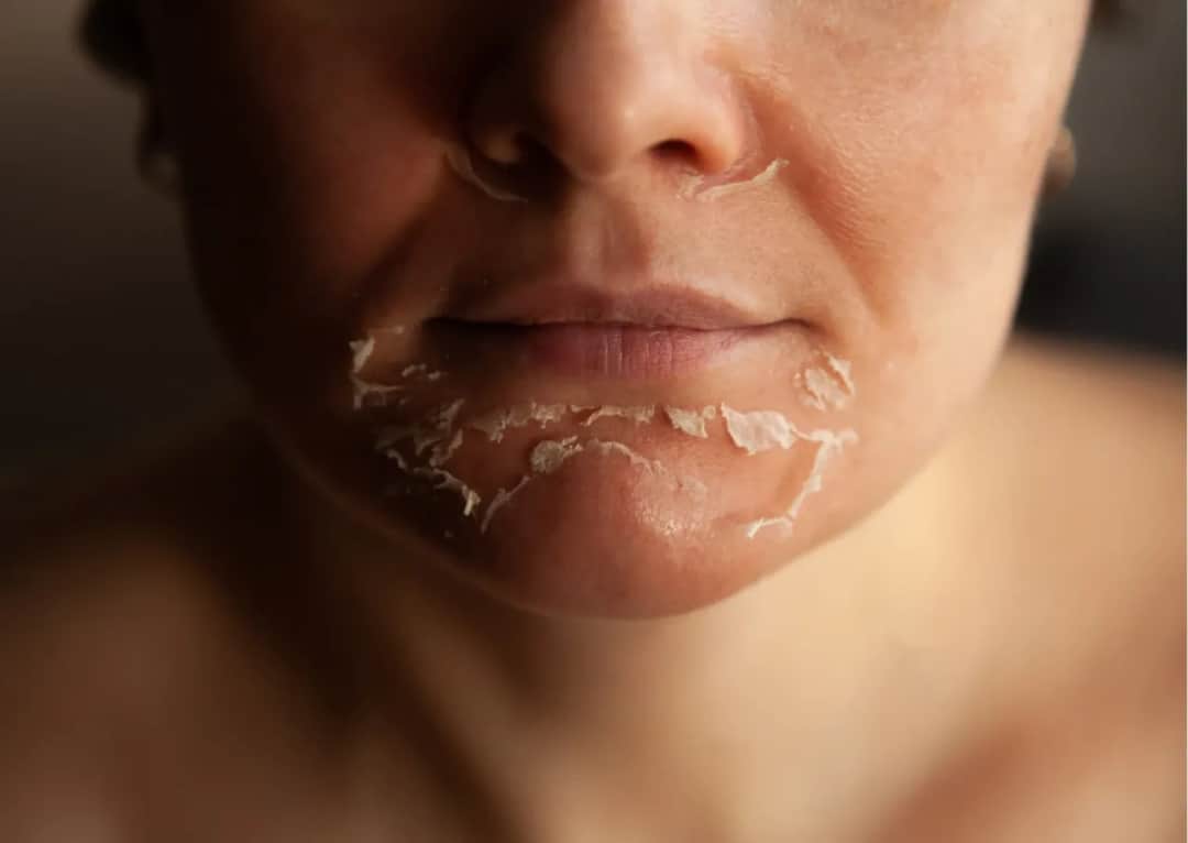 Jak wygląda twarz po kwasach? Najlepsze porady pielęgnacyjne