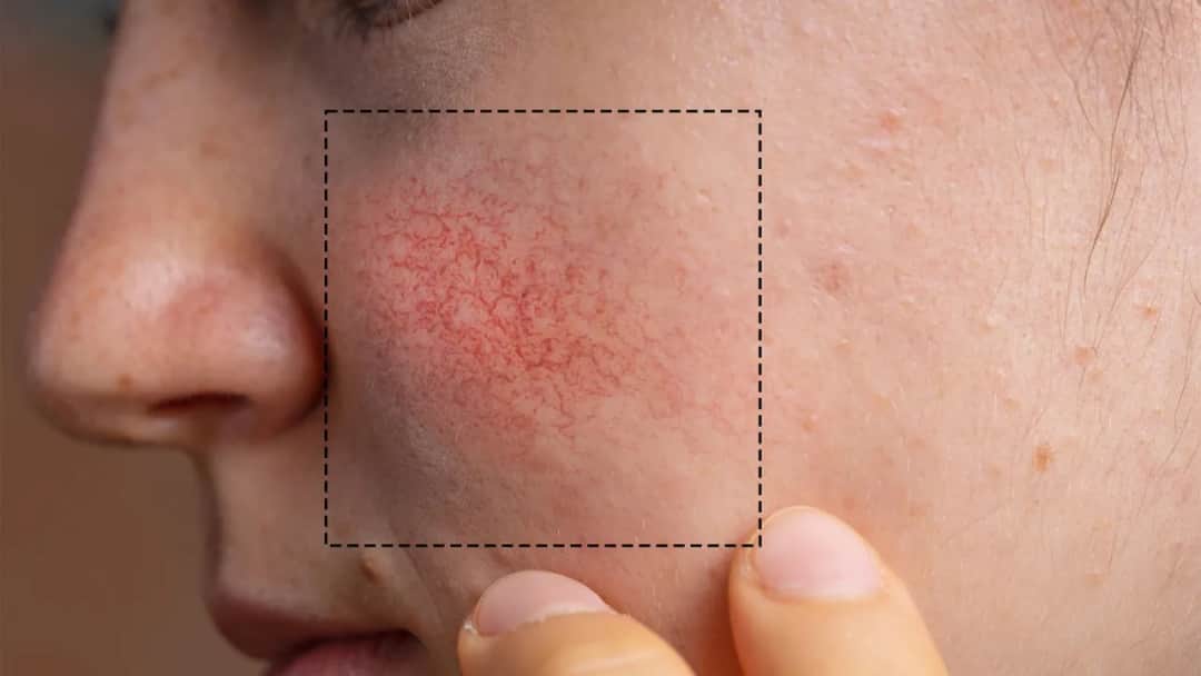 Czego unikać przy cerze naczynkowej, aby uniknąć podrażnień?