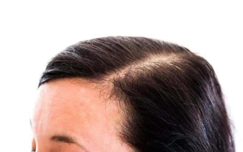 Przetłuszczające się i wypadające włosy: przyczyny i skuteczne rozwiązania Przetłuszczające się i wypadające włosy: przyczyny i skuteczne rozwiązania