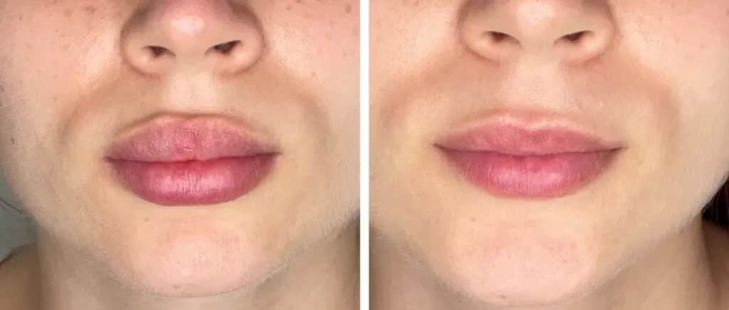 Jak szybko zmniejszyć opuchliznę po kwasie hialuronowym: 7 skutecznych metod