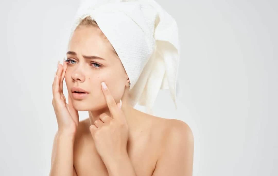 Jaki hydrolat do cery trądzikowej? Odkryj najlepsze rozwiązania dla skóry