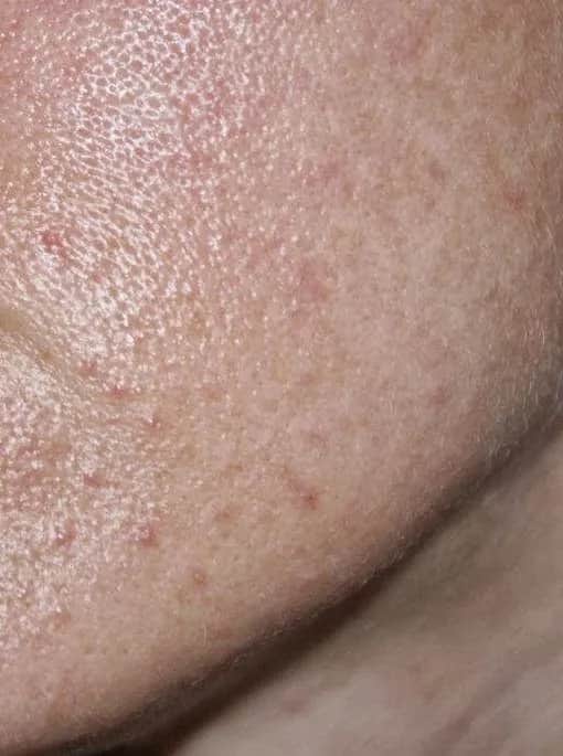 Jak wygląda zapchana cera? Objawy i skutki dla skóry