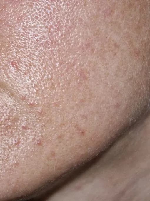 Jak wygląda zapchana cera? Objawy i skutki dla skóry