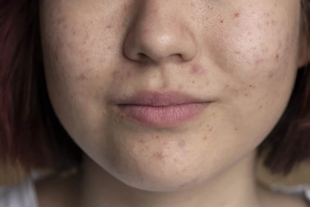 Skuteczne witaminy na cerę trądzikową: klucz do zdrowej skóry