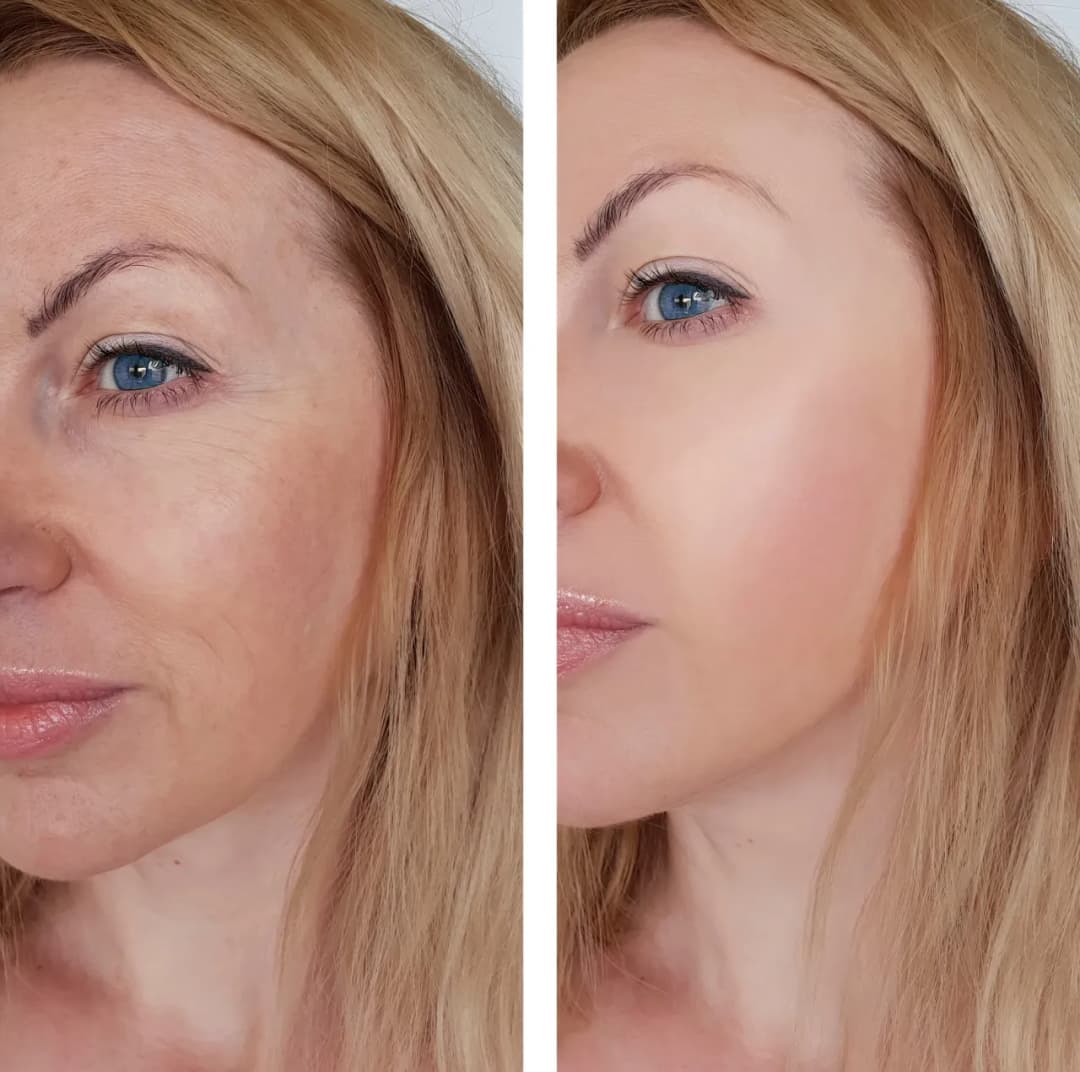 Peeling z retinolem: opinie, efekty i skutki uboczne zabiegu