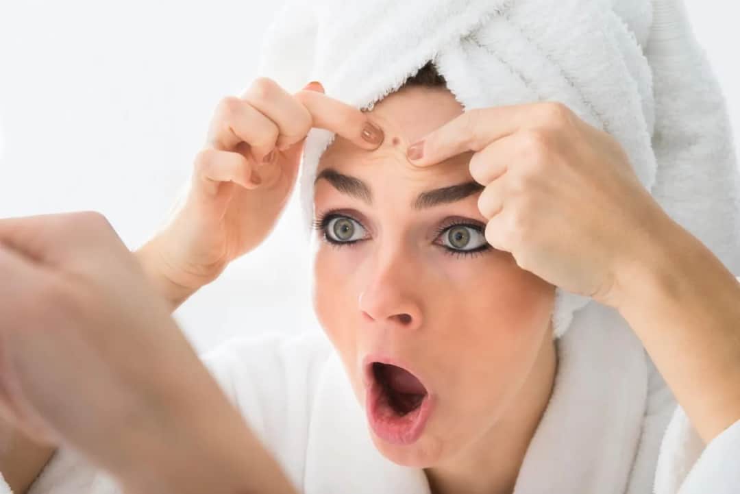 Pryszczy - jak sobie poradzić z nim domowymi sposobami?