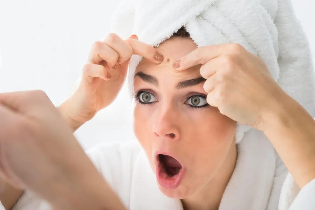 Pryszczy - jak sobie poradzić z nim domowymi sposobami?