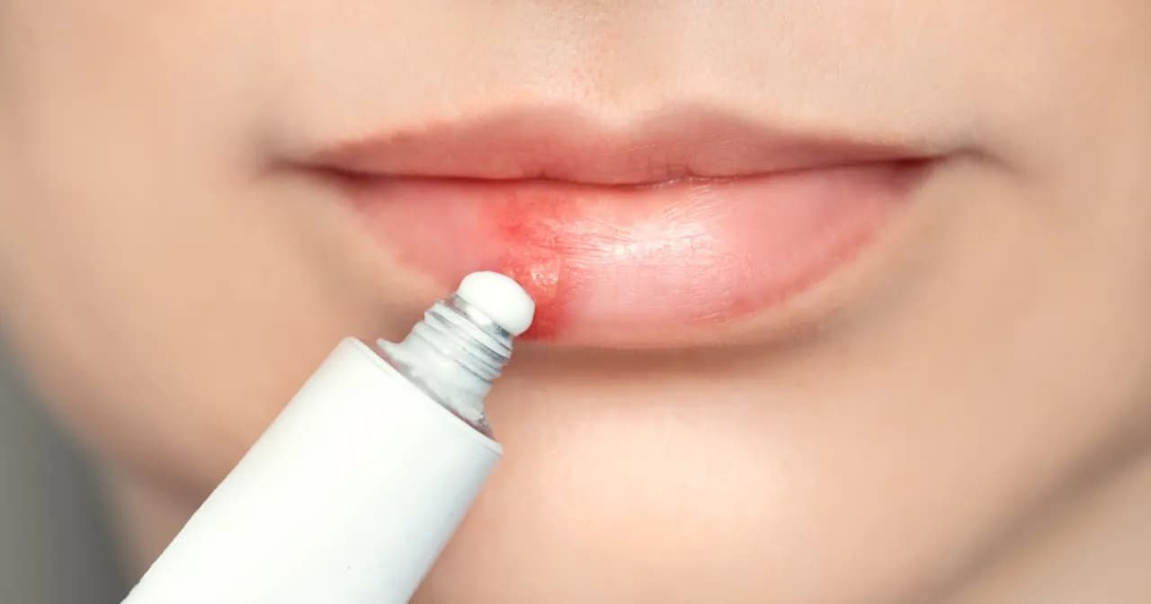 Opryszczka na ustach po makijażu permanentnym – jak skutecznie leczyć? Opryszczka na ustach po makijażu permanentnym – jak skutecznie leczyć?
