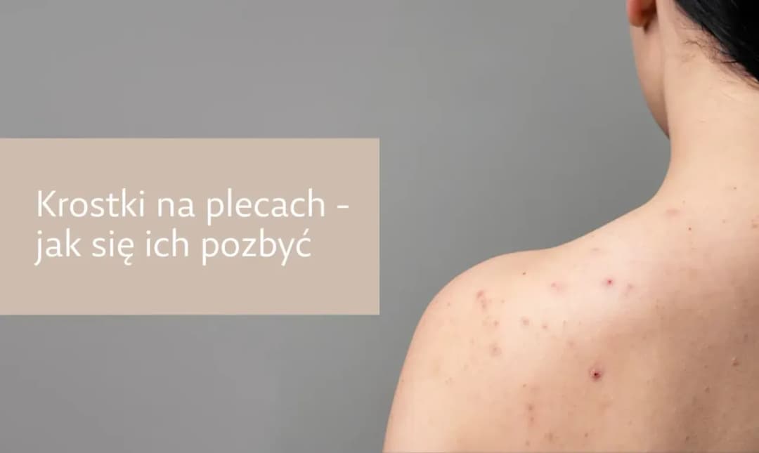 Blizny potrądzikowe na plecach - jak się ich skutecznie pozbyć?