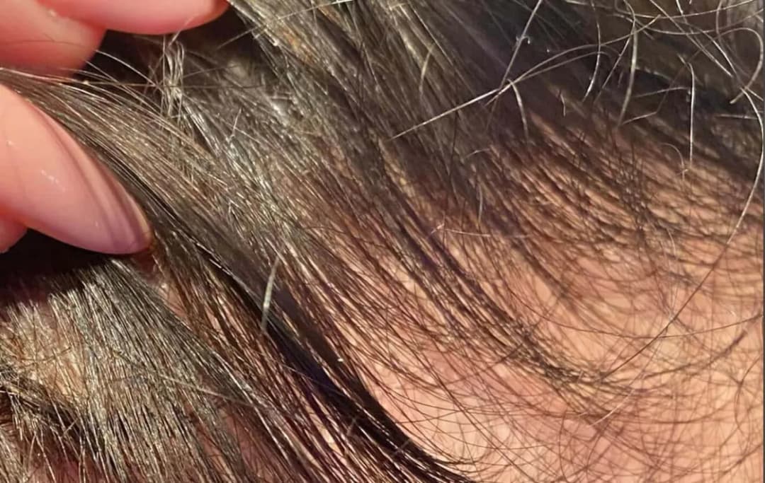 Wypadanie włosów u 15-latki: przyczyny i skuteczne leczenie Wypadanie włosów u 15-latki: przyczyny i skuteczne leczenie