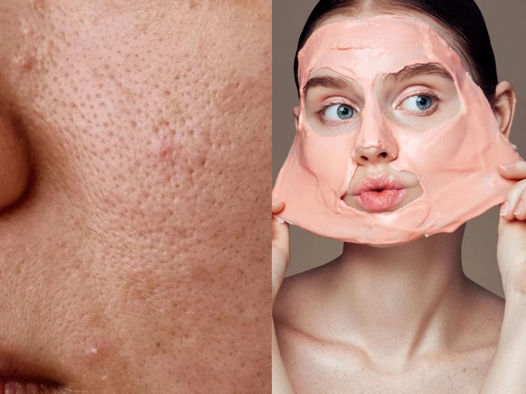 Jak wygląda zapchana cera i jak ją pielęgnować, by pozbyć się grudek?